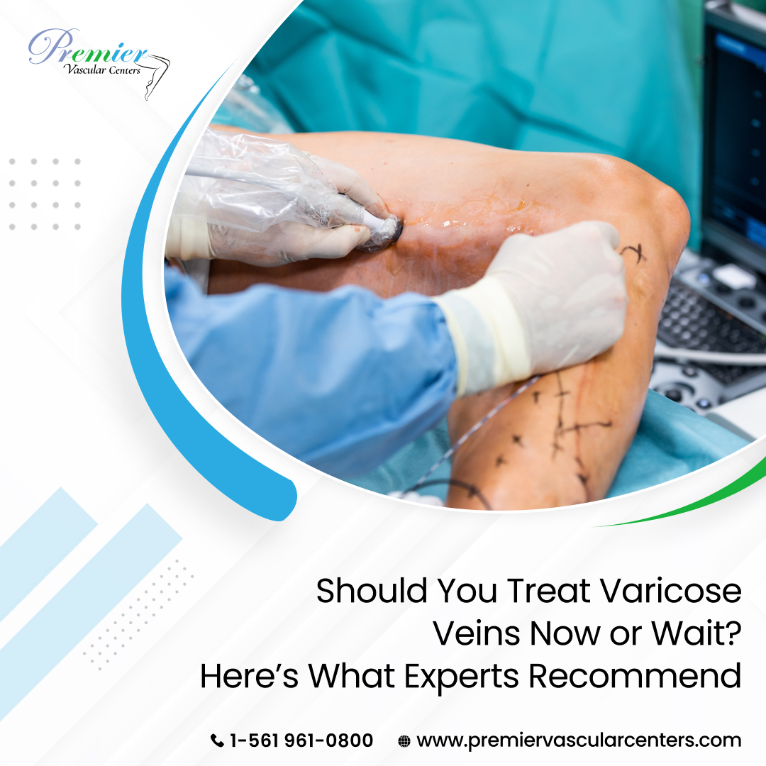 Varicose vein treatment in Boca Raton