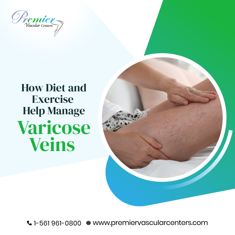 Varicose Veins Treatment Boca Raton