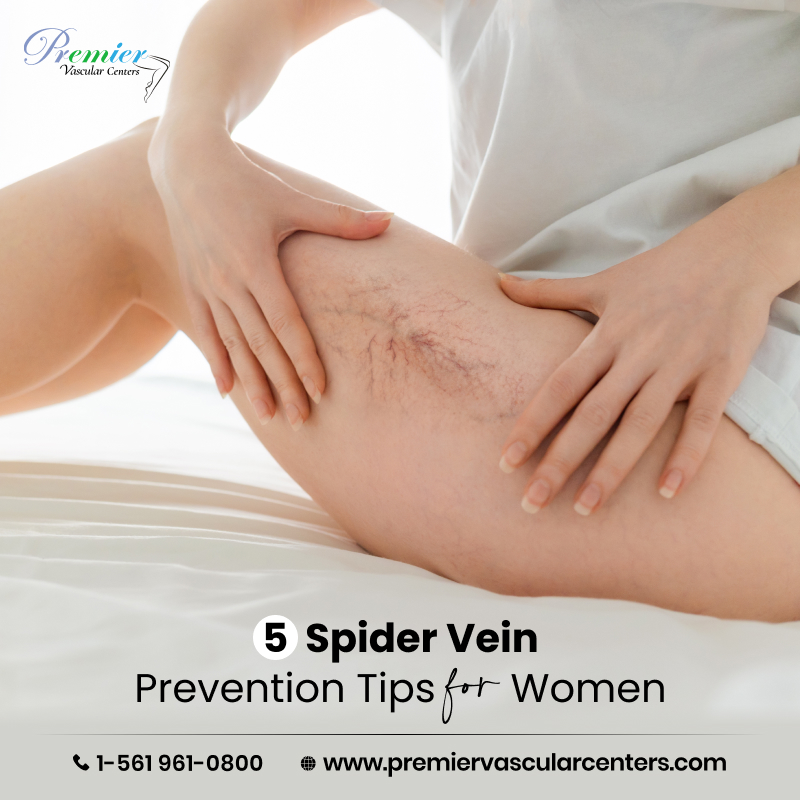 spider vein removal treatment in Boca Raton